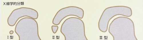 外販偏平足合併