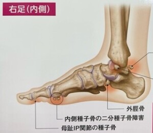 有痛性外脛骨障害