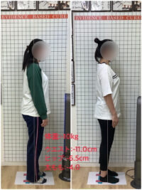 産後の骨盤矯正