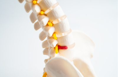 腰椎椎間板ヘルニア